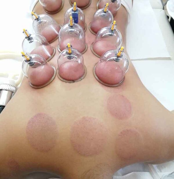 uomo si sottopone al trattamento estetico della coppettazione